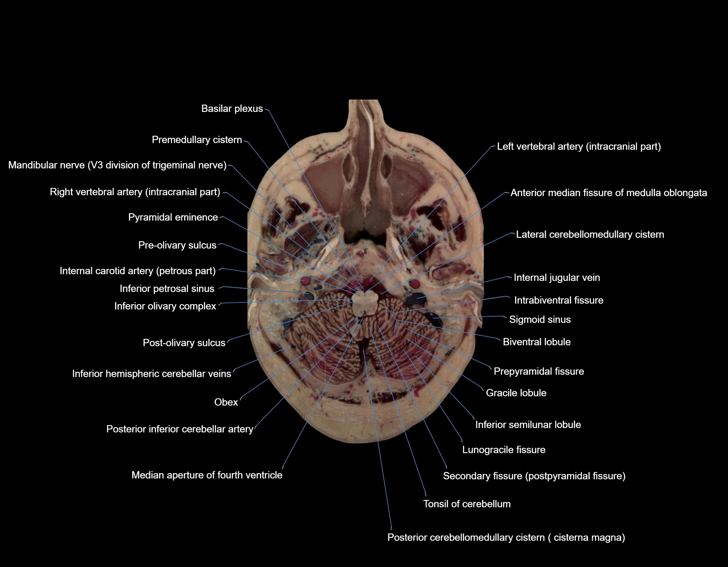 MRI Brain axial cross sectional radiology anatomy 3T image  -img-00009.webp